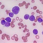 leukemia_sejt