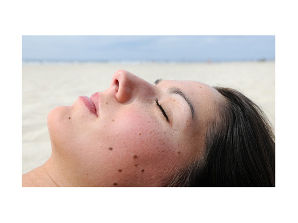 melanoma_borrak_napozas