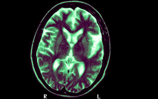 alzheimer_koros_agy_mri_felvetel