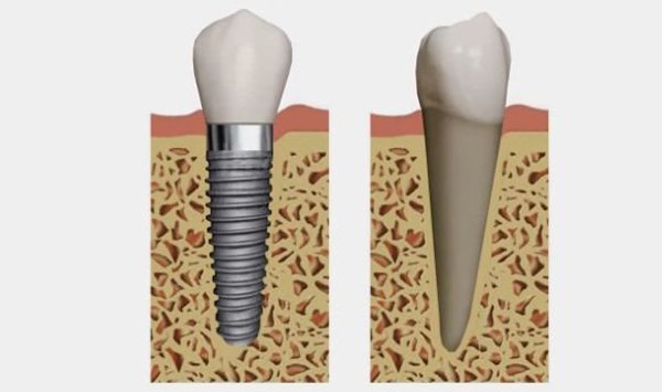 fog_implantatum_roman_uj_talalmany_2014