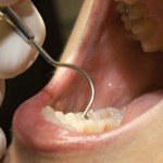 fogorvos_fogszuvasodas_fogaszat_kezeles